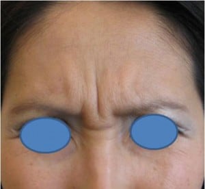 Frowning forehead with blue circles over eyes.