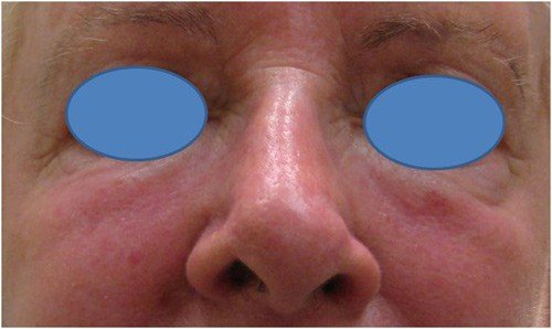 Close-up of a person's nose and surrounding facial area.