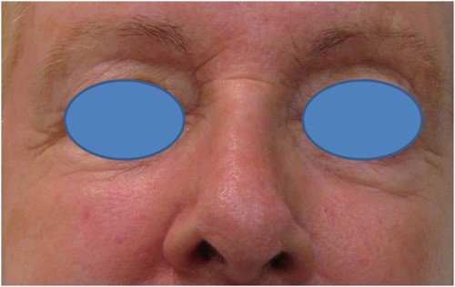 Close-up of a person's nose and eye area with blue ovals covering the eyes.