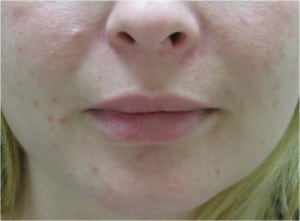 Juvederm for lip augmentation after