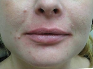 Juvederm for lip augmentation before