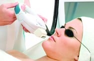 Woman undergoing laser hair removal on upper lip wearing protective glasses.