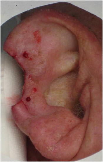 Close-up of oral mucosa with lesions and ulcerations.