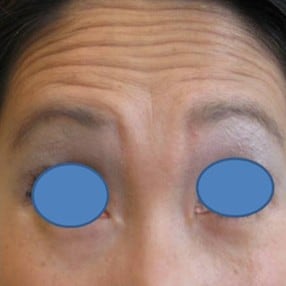 Close-up of forehead with prominent wrinkles above eyes.