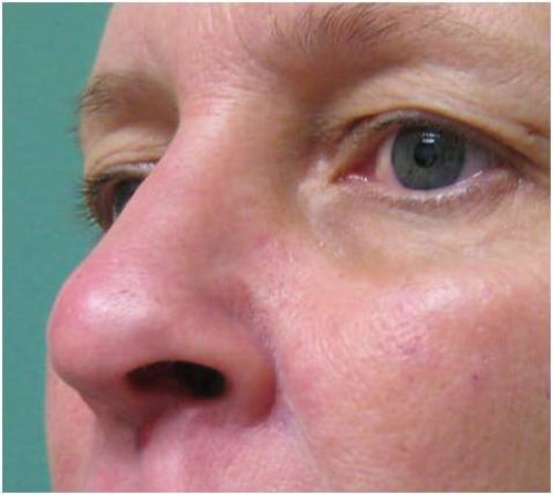 Close-up of a person's nose and eye area.