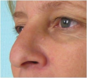 nose-reshaping-with-Radiesse-Before