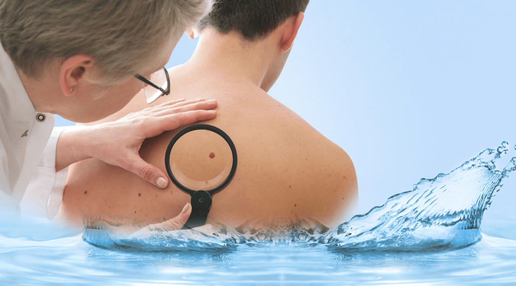 Dermatologist inspecting a shoulder mole with magnifier